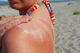 Image of Sunburn