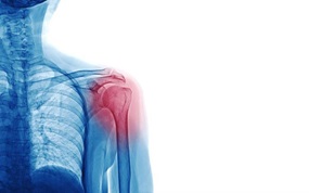 Shoulder Arthritis